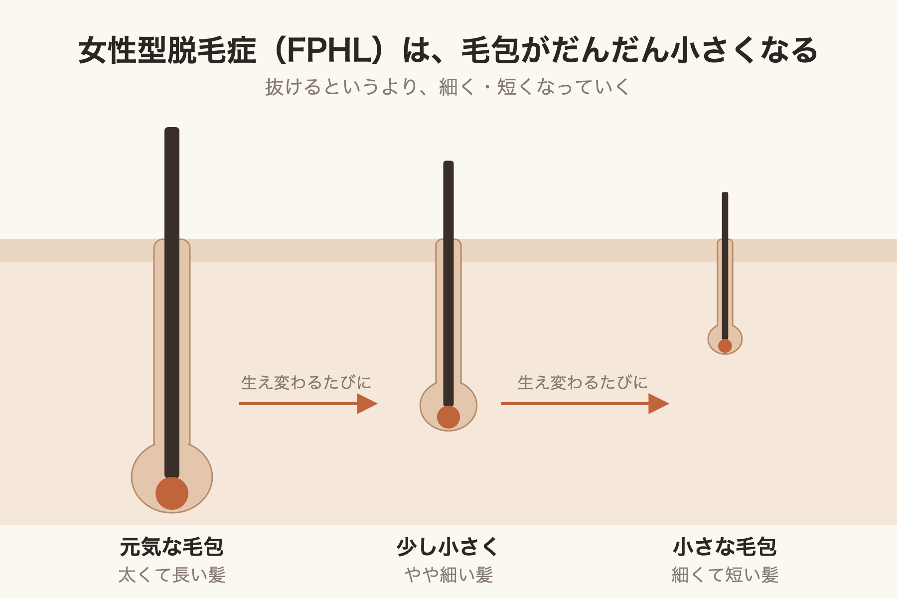 女性型脱毛症は毛包がだんだん小さくなる
